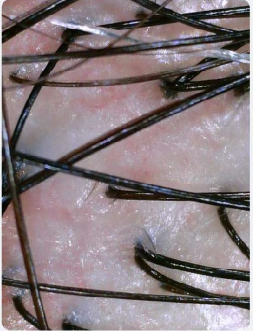 Imagem microscópica do couro cabeludo com fios e aberturas dos folículos