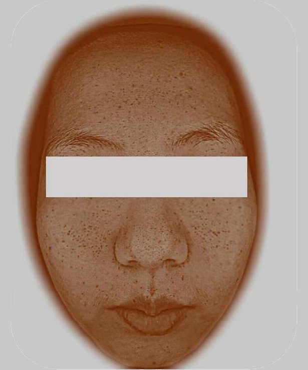 Rosto feminino sob luz marrom, com o acúmulo de melanina aparecendo como pontos escuros