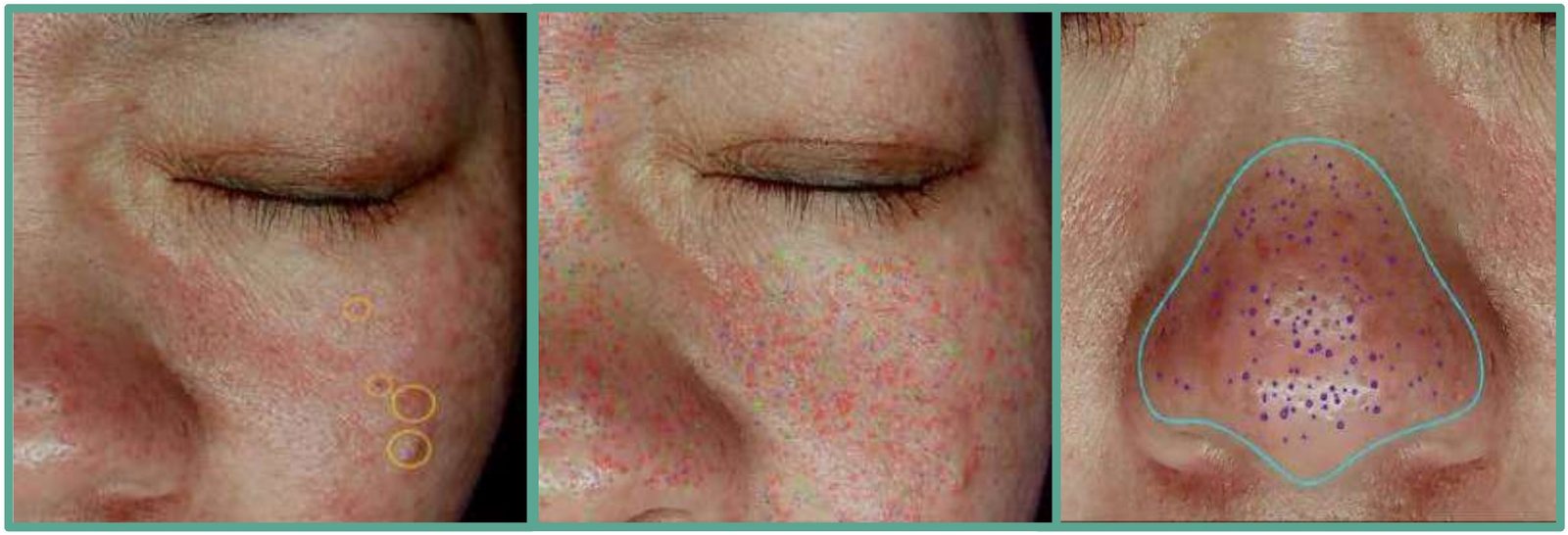 Três ampliações de pele com marcações do software contando acne, poros e cravos