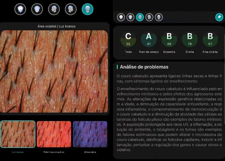 Duas telas de celular com o laudo do Trichovision em português: à esquerda a imagem do couro cabeludo sob luz branca, com miniaturas em outros espectros; à direita as notas por região da cabeça e a análise de problemas
