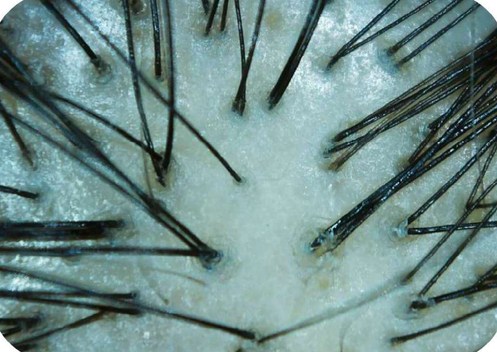 Imagem microscópica do couro cabeludo sob luz branca com fios e óstios foliculares