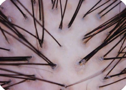 Imagem microscópica do couro cabeludo sob luz polarizada em tons rosados