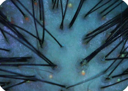 Imagem microscópica do couro cabeludo sob luz ultravioleta com pontos fluorescentes